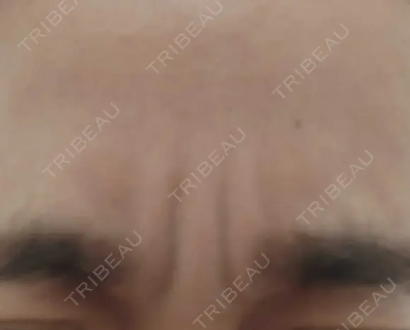 ボトックス（眉間） TCB東京中央美容外科 新横浜院 BEFORE メイン用