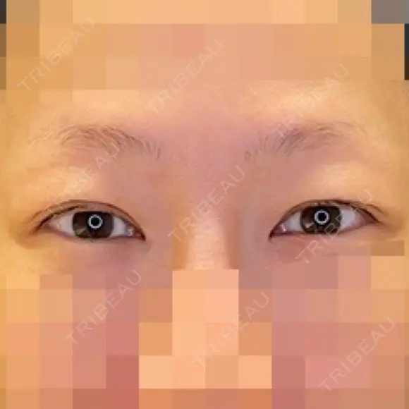 目尻切開 / タレ目形成・グラマラスライン（埋没） LOUIS CLINIC 二子玉川院【ルイクリニック】 BEFORE メイン用