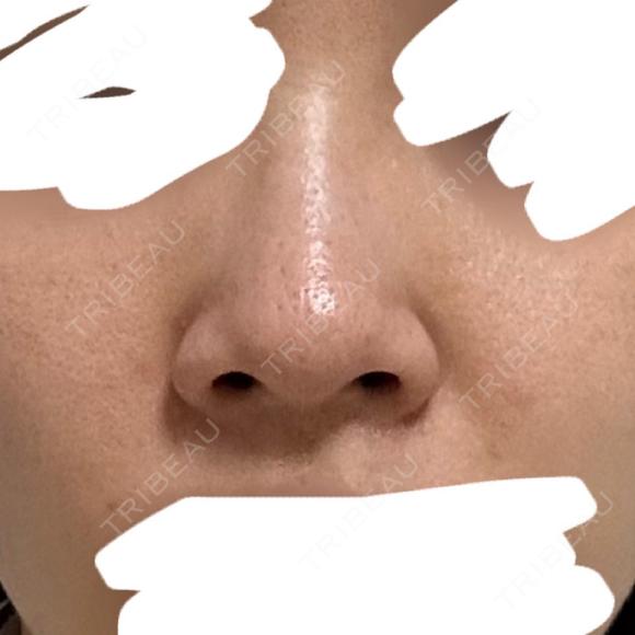 鼻尖形成（切開） / 軟骨移植 / 鼻尖縮小 ASTRA BEAUTY CLINIC BEFORE メイン用