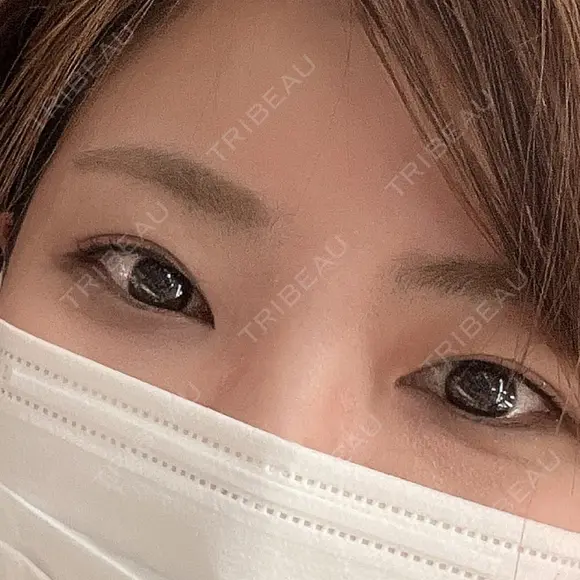 二重埋没 ルラ美容クリニック 神戸院 BEFORE メイン用