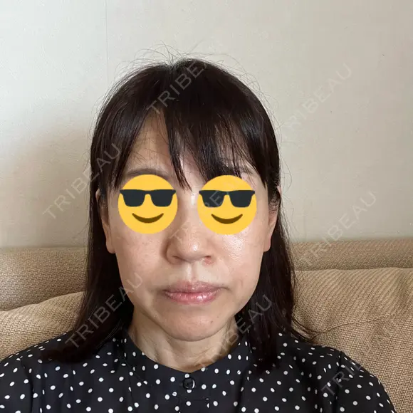 鼻尖形成（切開） / 鼻中隔延長（切開） / 小鼻縮小（切開） / 鼻尖縮小 グローバルビューティークリニック 東京院 BEFORE メイン用