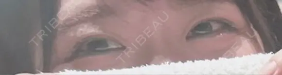 二重埋没 TCB東京中央美容外科 青森院 BEFORE メイン用