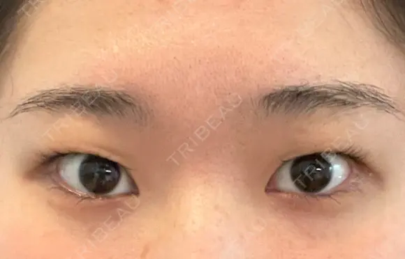 二重埋没 表参道スキンクリニック 表参道院 BEFORE メイン用