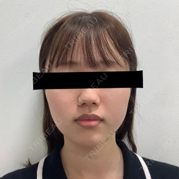 糸リフト / バッカルファット除去 SEA CLINIC（シークリニック） BEFORE メイン用