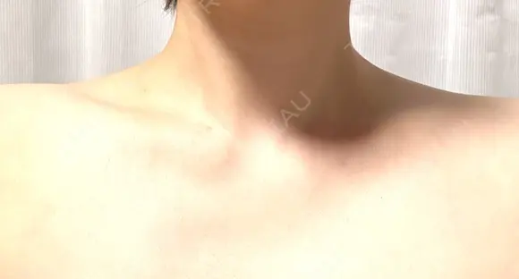 ボトックス（肩） 湘南美容クリニック 静岡院 BEFORE メイン用