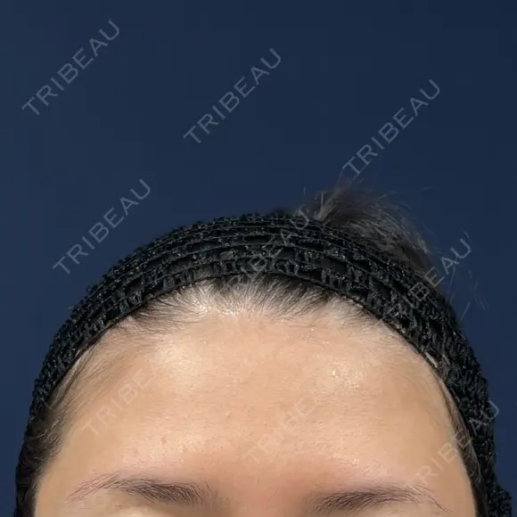 脂肪注入（額） S.T styleクリニック BEFORE メイン用