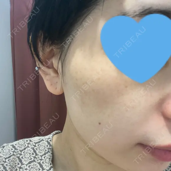 光治療（フォトフェイシャルなど） メディアージュクリニック 名古屋院 BEFORE メイン用