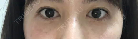 二重埋没 お茶の水美容形成クリニック BEFORE メイン用