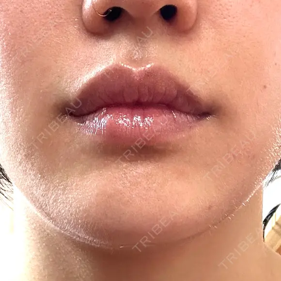 その他（目元） / ボトックス（口角） / ボトックス（人中） ルラ美容クリニック 渋谷本院 BEFORE メイン用