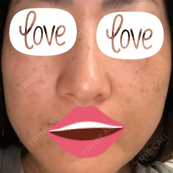 プラセンタ注射 / シミ取りレーザー 仁愛クリニック BEFORE メイン用