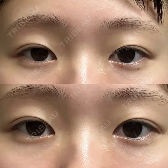 ボトックス（目尻） SK新宿歌舞伎町美容外科・歯科 BEFORE メイン用