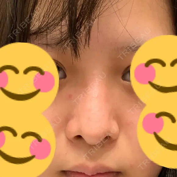 目頭切開 / その他（鼻） / ヒアルロン酸注入（鼻） BIANCA銀座 BEFORE メイン用