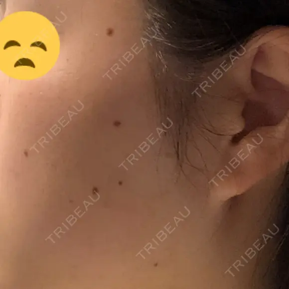 ほくろ・いぼ切除（肌） リメイ皮膚科 BEFORE メイン用