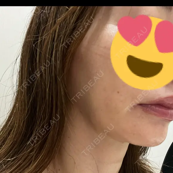 ヒアルロン酸注入（頬） 藤・ナチュレ美容クリニック 銀座院 BEFORE メイン用