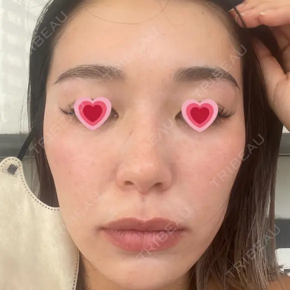 光治療（フォトフェイシャルなど） APOLLO BEAUTY CLINIC BEFORE メイン用