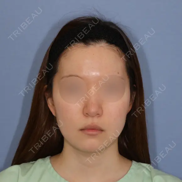 糸リフト / 脂肪吸引（顔） 加藤クリニック 麻布東京院 BEFORE メイン用