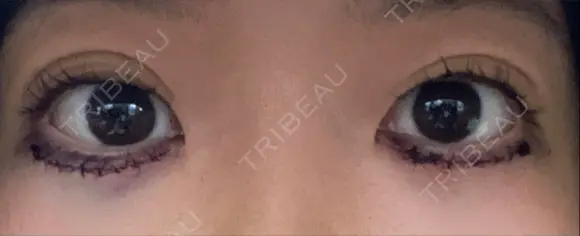 下まぶたたるみ取り きれいクリニック BEFORE メイン用