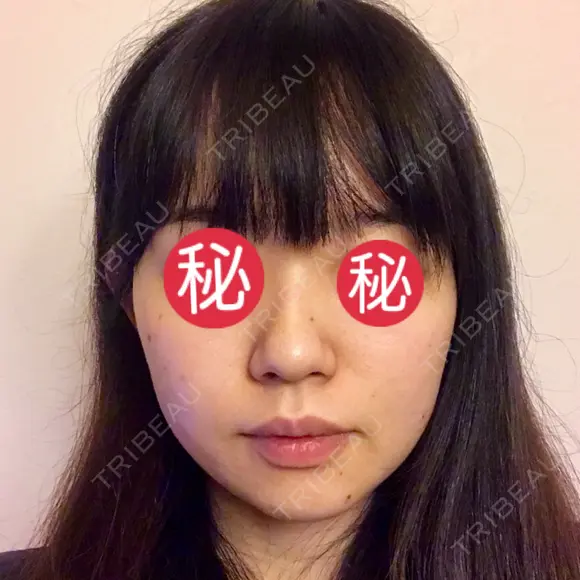 隆鼻術 / 鼻尖形成（切開） / 軟骨移植 / ワシ鼻修正・ハンプ切除 / 鼻尖縮小 表参道スキンクリニック 表参道院 BEFORE メイン用
