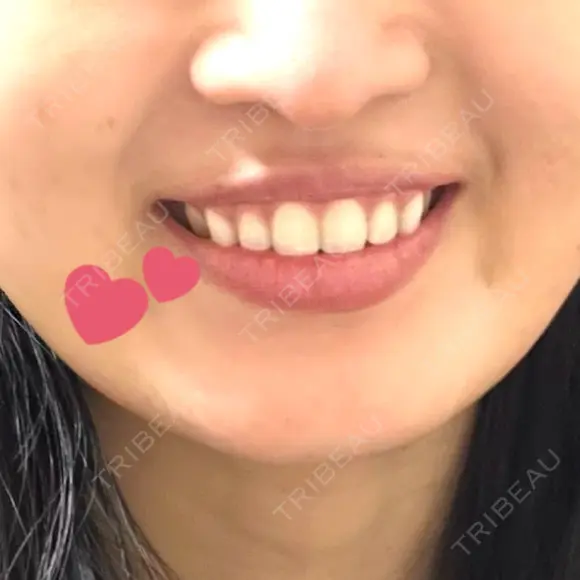 ボトックス（あご） Original Beauty Clinic GINZA BEFORE メイン用