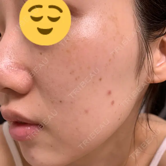 シミ取りレーザー CLINICA BellaForma BEFORE メイン用