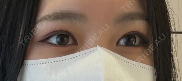 その他（目元） / 上まぶたの脂肪取り 9BeautyClinic BEFORE メイン用