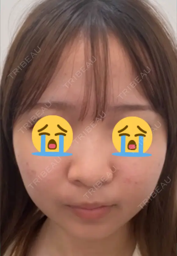 鼻尖形成（切開） / 小鼻縮小（切開） / 軟骨移植 / 鼻柱下降・鼻唇角形成（猫手術） / ヒアルロン酸注入（あご） グローバルビューティークリニック 東京院 BEFORE メイン用