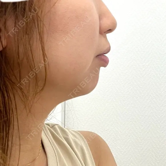 ヒアルロン酸注入（あご） 川越TAクリニックアソシエ BEFORE メイン用