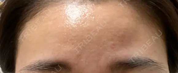 ヒアルロン酸注入（あご） / ヒアルロン酸注入（額） / ボトックス（眉間） / ピコレーザートーニング（美白・肝斑） THE FIRST CLINIC 多摩センター院 BEFORE メイン用