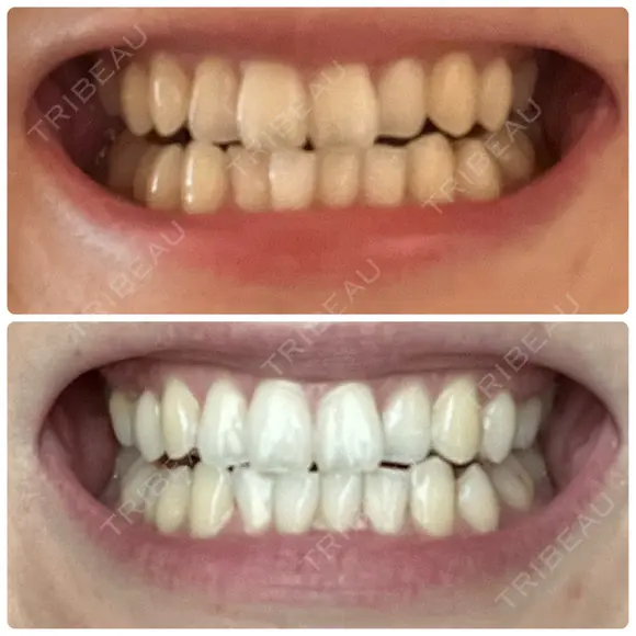 ホワイトニング / その他（審美歯科/矯正歯科） 池袋麗歯科・美容皮膚科 BEFORE メイン用