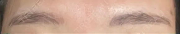アートメイク（眉） ミケイ医院 BEFORE メイン用