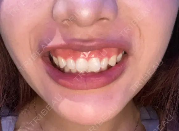 ボトックス（あご） / ボトックス（人中） Tokyo Tensei Clinic 新宿院 BEFORE メイン用