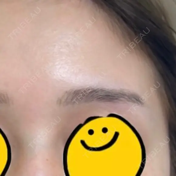 アートメイク（ほくろ） メディカルアートメイク大阪 BEFORE メイン用