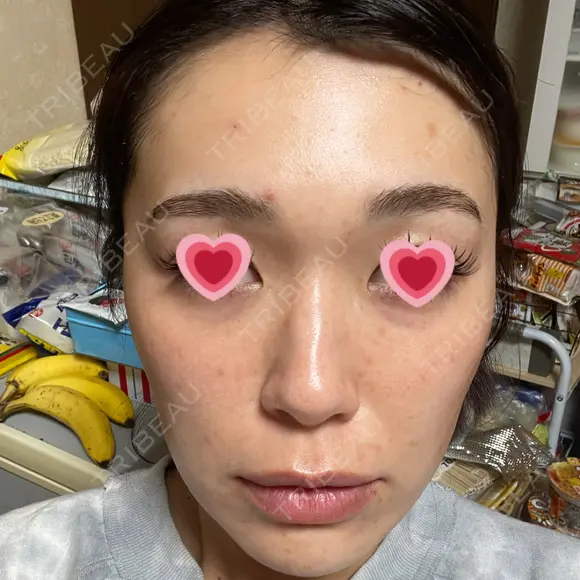 LED治療 The Natural Beauty Clinic 恵比寿院 BEFORE メイン用