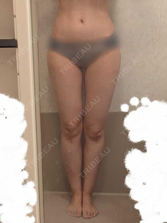 脂肪吸引（脚） / 豊胸（脂肪注入） オアシス美容外科 BEFORE メイン用