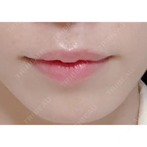 ヒアルロン酸注入（唇） あじまビューティークリニック BEFORE メイン用
