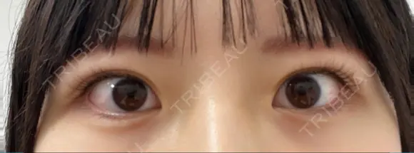 ヒアルロン酸注入（涙袋） フィラークリニック 大阪心斎橋院 BEFORE メイン用