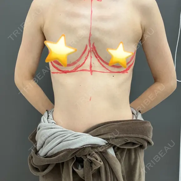 豊胸（シリコンバッグ） お茶の水美容形成クリニック BEFORE メイン用