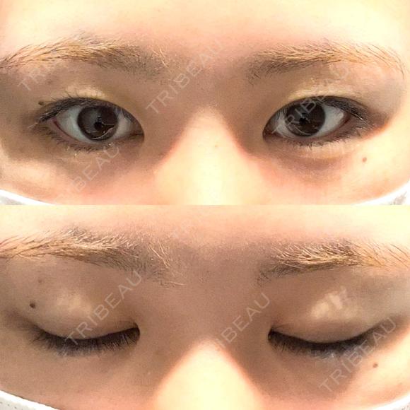 二重切開 つだ美容外科クリニック BEFORE メイン用