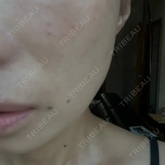 その他（肌） / ピーリング（ニキビ・毛穴） / ピーリング（ハリ・ツヤ） AURORA CLINIC（オーロラクリニック）新宿院 BEFORE メイン用