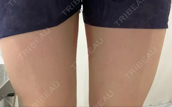 脂肪冷却（太もも） THE GINZA CLINIC BEFORE メイン用