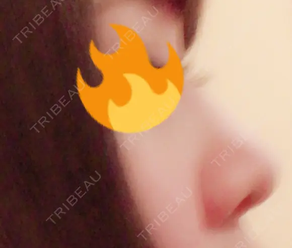 鼻尖形成（切開） / 軟骨移植 / ワシ鼻修正・ハンプ切除 / 小鼻縮小（非切開） 東京シンデレラ美容外科 池袋院 BEFORE メイン用