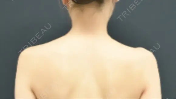 ボトックス（肩） 湘南美容クリニック 京都院 BEFORE メイン用