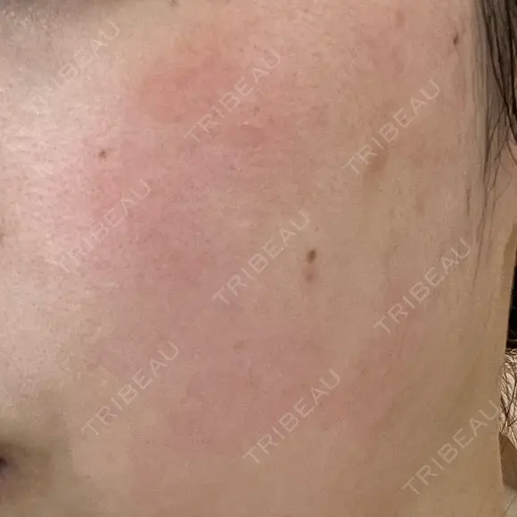 ピーリング（ニキビ・毛穴） LIFIX BEAUTY CLINIC BEFORE メイン用