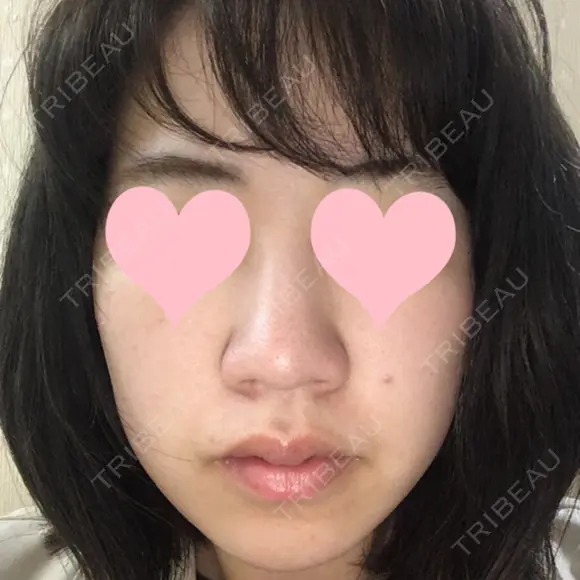 小鼻縮小（切開） JUN CLINIC BEFORE メイン用