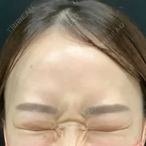 その他（目元） / ボトックス（エラ・小顔） 湘南美容クリニック 京都院 BEFORE メイン用