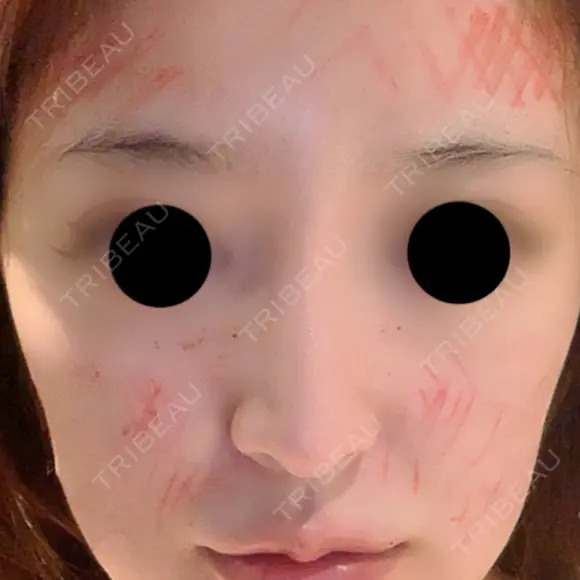 鼻尖形成（切開） / 鼻中隔延長（切開） / 脂肪注入（額） / 脂肪注入（輪郭） ビーザニュー美容整形外科（旧コノピ美容整形外科） BEFORE メイン用