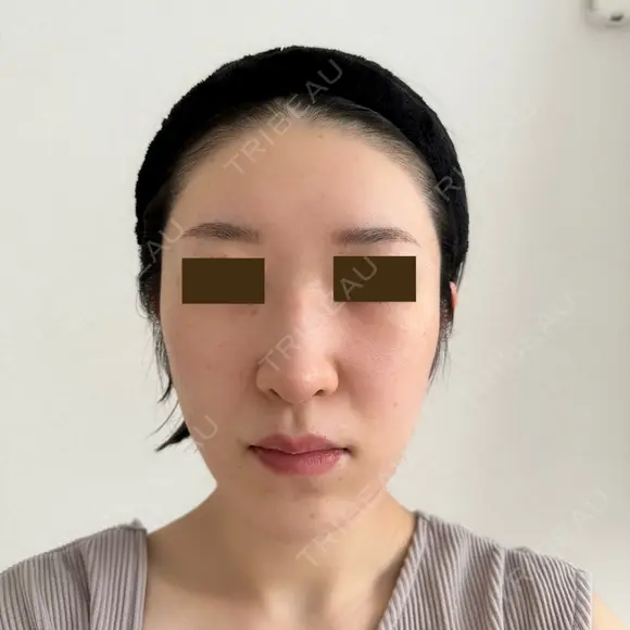 糸リフト / 額を丸く / 真皮移植 / 脂肪注入（額） / 切開リフト / 脂肪注入（輪郭） eクリニック 金沢本院 BEFORE メイン用