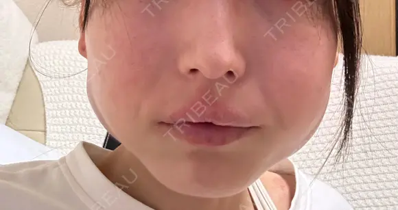 ボトックス（エラ・小顔） 湘南美容クリニック 岐阜院 BEFORE メイン用