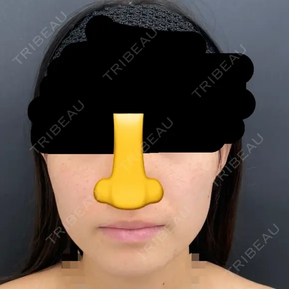 糸リフト / 脂肪吸引（顔） / ジョールファット除去 / ボトックス（エラ・小顔） ルラ美容クリニック 新宿院 BEFORE メイン用