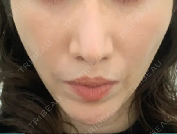 脂肪吸引注射（顔） イテウォンビューティークリニック 名古屋栄院 BEFORE メイン用